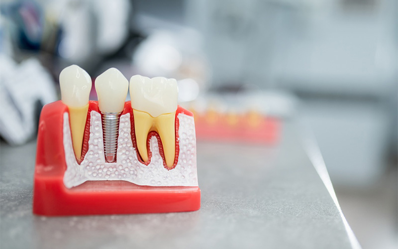 Anatomical model of a jaw, teeth, implants, implant placement, dental implantation. Close-up of dental instruments, a probe, and a mirror. Titanium screw.