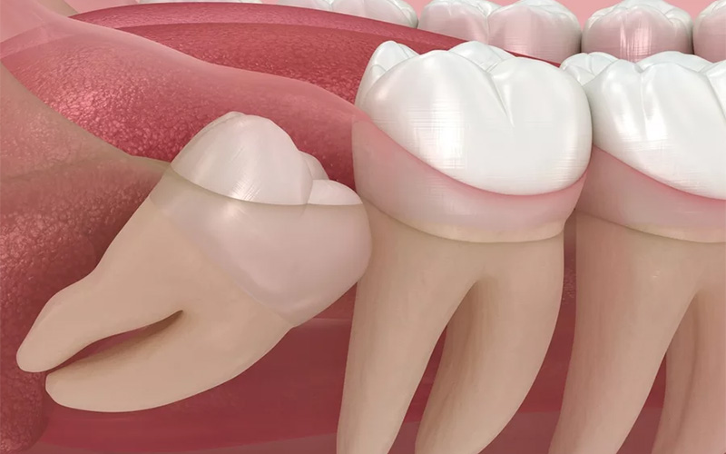 Abnormal position of wisdom teeth. Medically accurate tooth 3D illustration.