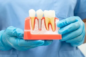 Dental implant, artificial tooth roots into jaw, root canal of dental treatment, gum disease, teeth model for dentist studying about dentistry.